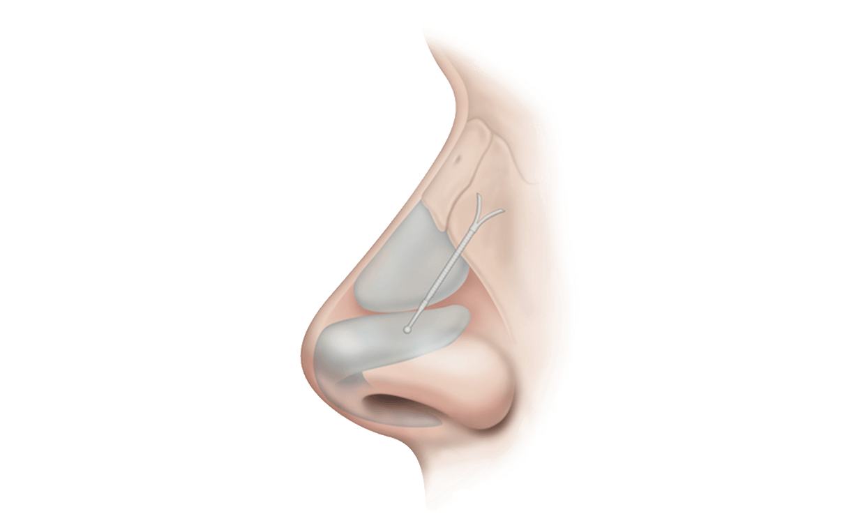 latera implant