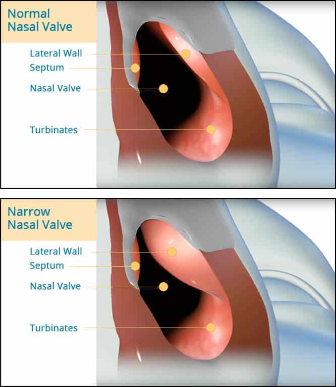 vivaer nasal obstruction treatment boynton beach 1