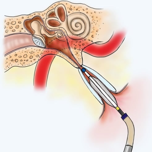 middle ear dilation