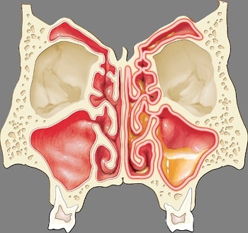 Image Healthy vs Diseased Sinus Anatomy78