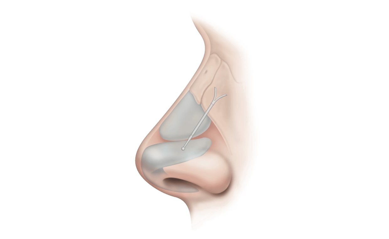 latera implant